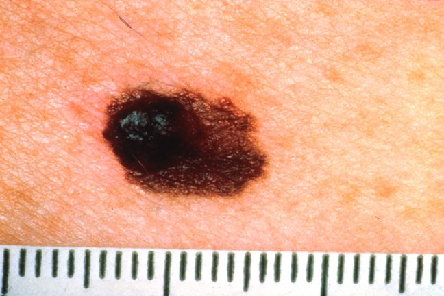 ABCDE rule for melanoma detection — Asymmetry, Border, Color, Diameter, Evolution