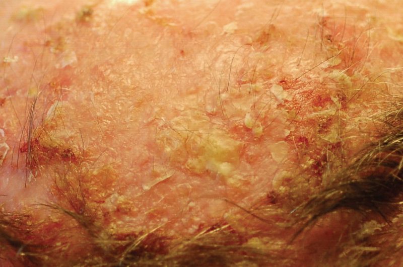 Actinic keratosis — multiple rough, scaly pre-cancerous lesions on scalp from sun damage