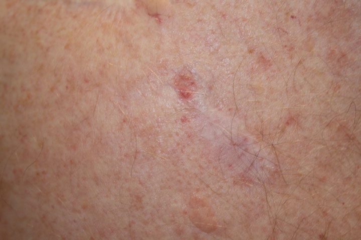Nodular basal cell carcinoma — pearly flesh-colored nodule on skin