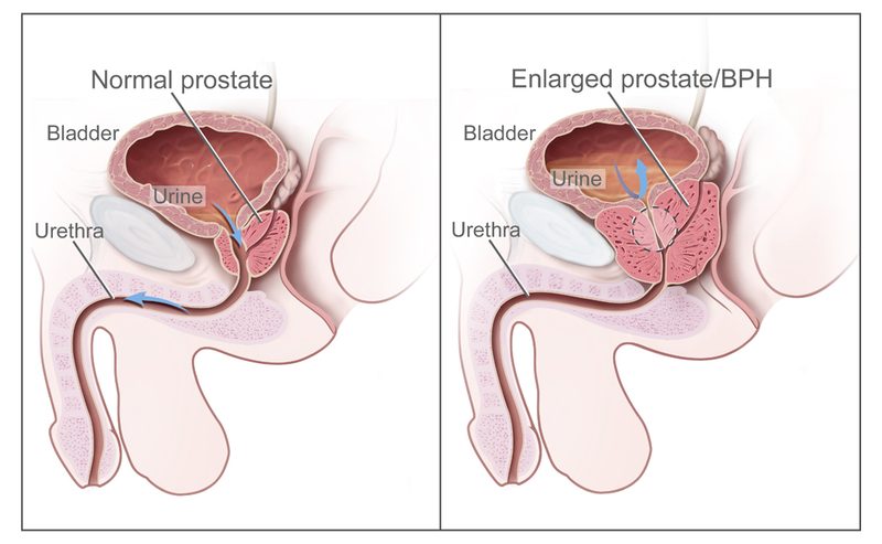 NCI illustration comparing normal prostate to enlarged prostate (BPH) blocking urine flow