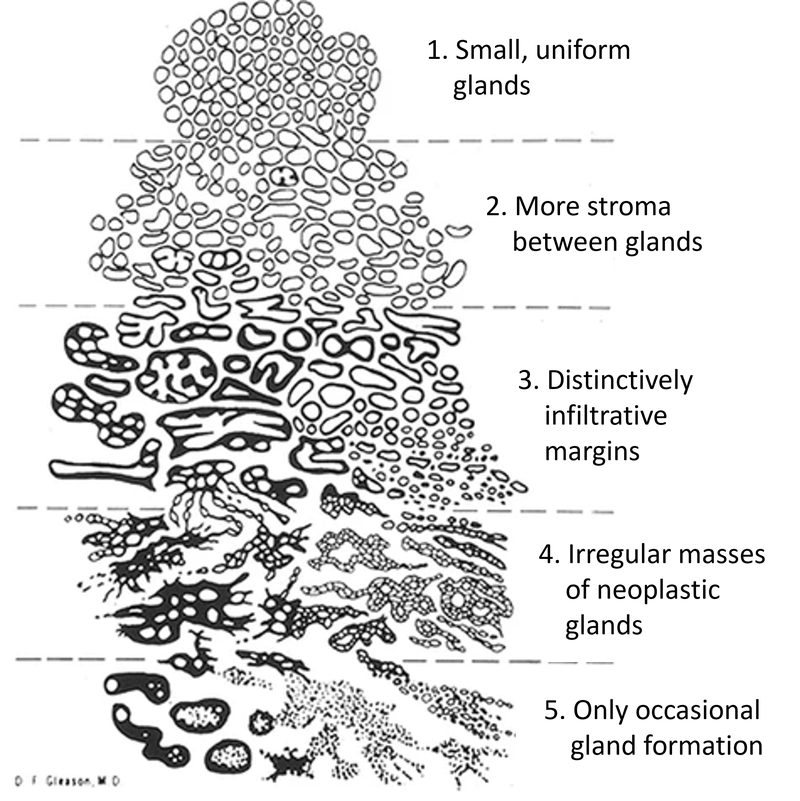 Gleason grading system diagram showing grades 1-5 of prostate cancer tissue