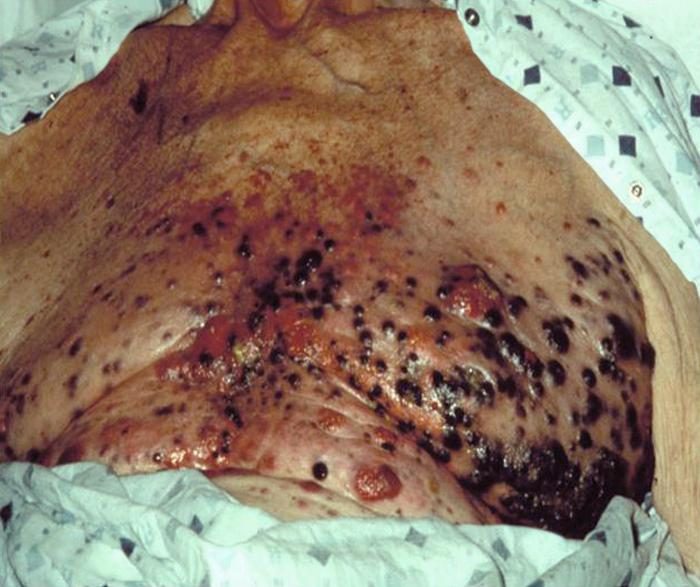 Malignant melanoma showing asymmetry, irregular borders, and color variation