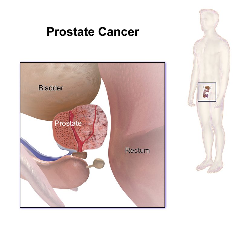 Medical illustration showing prostate cancer anatomy and location