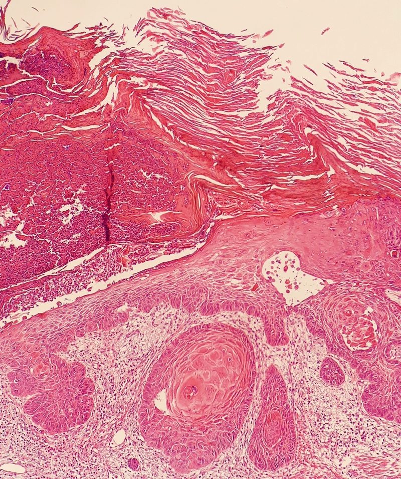 Squamous cell carcinoma — scaly, ulcerated lesion